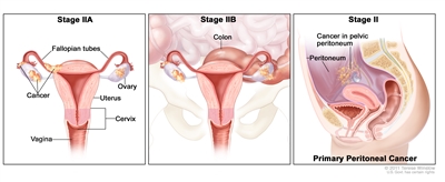 Three-panel drawing of stage IIA, IIB, and stage II primary peritoneal cancer; the first panel (stage IIA) shows cancer inside both ovaries that has spread to the uterus and fallopian tube. The second panel (stage IIB) shows cancer inside both ovaries that has spread to the colon. The third panel (stage II primary peritoneal cancer) shows cancer in the pelvic peritoneum. Also shown are the cervix and vagina.